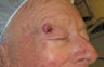 Mole/tumor removal from eyebrow using plastic surgery techniques
