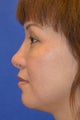Asian Rhinoplasty, Augmentation with Cartilage