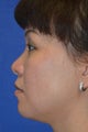 Asian Rhinoplasty, Augmentation with Cartilage