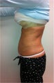 Laser Lipo