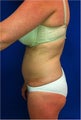 Laser Lipo