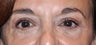 62 Year Old Female Treated For Tired and Puffy Eyes