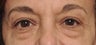 62 Year Old Female Treated For Tired and Puffy Eyes