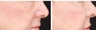Cheek augmentation with Radiesse in a 75-year-old woman