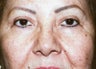 Upper Blepharoplasty