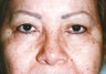 Upper Blepharoplasty