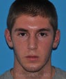 Rhinoplasty and chin augmentation in young male