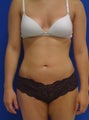 Laser Liposuction