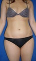 Laser Liposuction