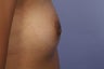 Inverted Nipple Repair