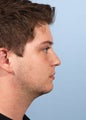 Male Chin Implant