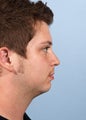 Male Chin Implant