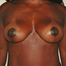 Breast Lift