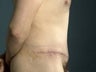 Male Abdominoplasty