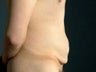 Male Abdominoplasty