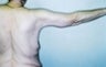 Female patient who underwent an arm lift
