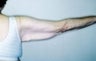 Female patient who underwent an arm lift