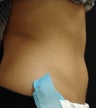 Coolsculpting