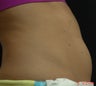 Coolsculpting