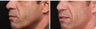 Fraxel laser for Acne Scars