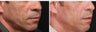 Fraxel laser for Acne Scars