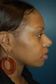 Nose Surgery