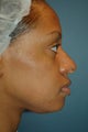 Nose Surgery