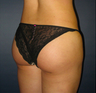 Breast Augmentation
