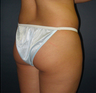 Breast Augmentation