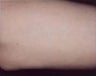 Laser Hair Removal