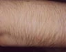 Laser Hair Removal