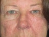 Eyelid and cheek basal cell carcinoma