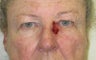 Eyelid and cheek basal cell carcinoma