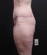 This patient underwent a lower body lift to correct excess skin after massive weight loss.