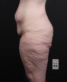 This patient underwent a lower body lift to correct excess skin after massive weight loss.