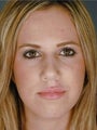 Female Primary Rhinoplasty