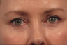Upper and lower blepharoplasty