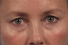 Upper and lower blepharoplasty