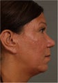 44 year old female with weak chin
