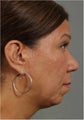 44 year old female with weak chin