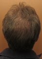 Neograft hair restoration FUE