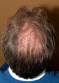 Neograft hair restoration FUE