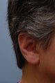 Incision less Otoplasty