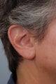 Incision less Otoplasty