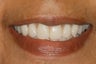 Replacement of hopeless teeth with implant supported bridge.