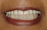Replacement of hopeless teeth with implant supported bridge.