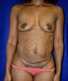 Mommy Makeover with tummy tuck and breast augmentation