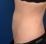 Liposuction Lower Abdomen