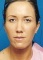 Chin Augmentation