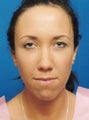 Chin Augmentation